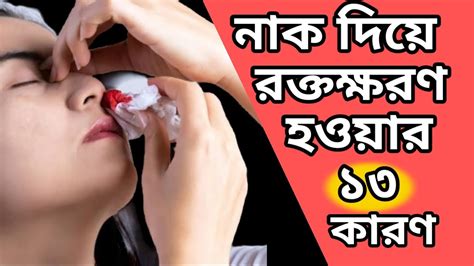 নাক দিয়ে রক্ত পড়ার ১৩ কারন 13 Reasons For Nosebleeds Cp Dr Abdur