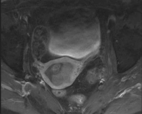 Diffusion Weighted Mr Imaging Of Female Pelvic Tumors A Pictorial