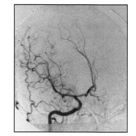 Cerebral Angiogram February A Ap Right Carotid Injection