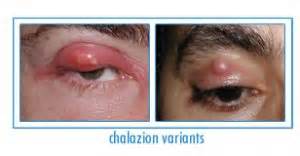 Chalazion Surgery New York City Stye Treatment Manhattan Dr Brazzo