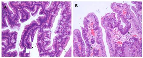 Sessile Serrated Adenoma Histology