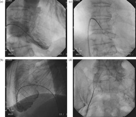 Complete Atrioventricular Block Due To Venous Stent Migration From