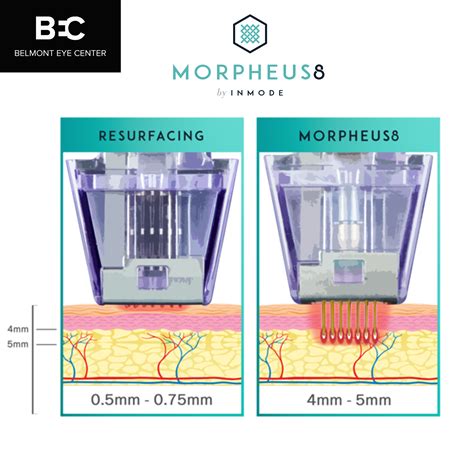 Morpheus8 Introduction On Non Surgical Enhancement Belmont Eye Center