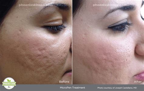 Explore Micro Needling With Prp At Phoenix Skin Spa