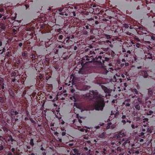 The pathological diagnosis was pulmonary botryomycosis. | Download Scientific Diagram