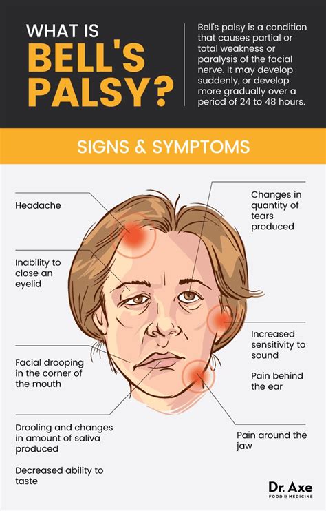 My Personal Bells Palsy Journey