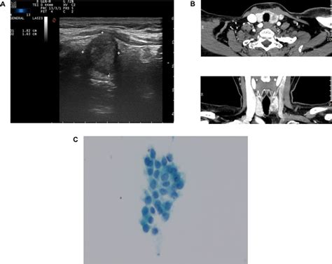 Preoperative data. A Thyroid ultrasonography revealed a solid mass with ...