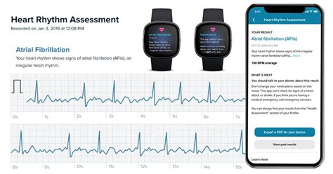 Ecg Monitor Fitbit At Laura Hefley Blog