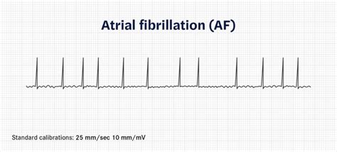 How To Calculate Heart Rate From Ecg Or Ekg Seer Medical