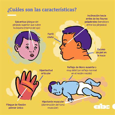 Caracteristicas Del Sindrome De Down