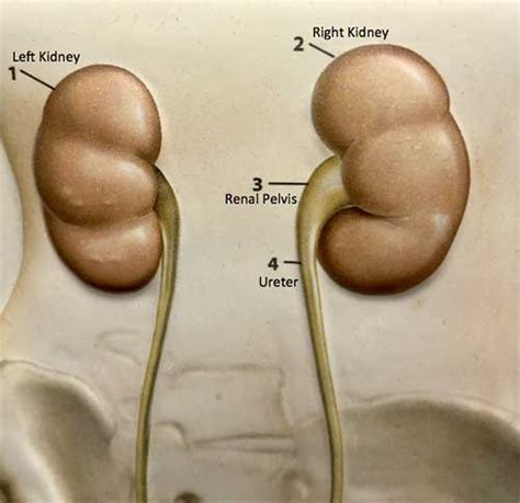 Uretero Pelvic Junction Obstruction Upj Obstruction The Urology