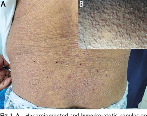 Figure 1 From Generalized Lichen Amyloidosis And Hyperthyroidism