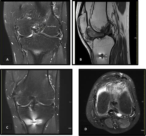 A-D, MRI examination showing cyclops lesion. A, MRI coronal T2 weighted ...