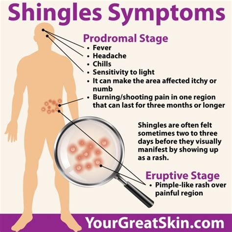 Tips For Treating And Preventing Shingles Your Great Skin