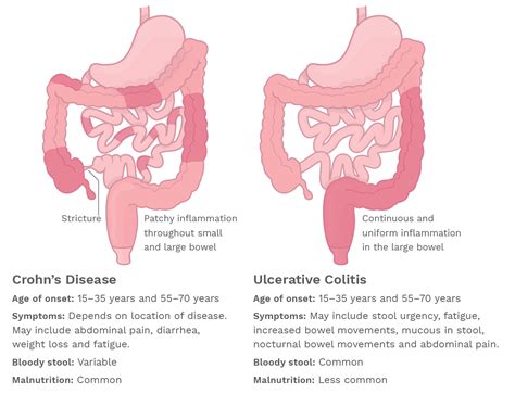 Inflammatory Bowel Disease Rush Emergency Medicine