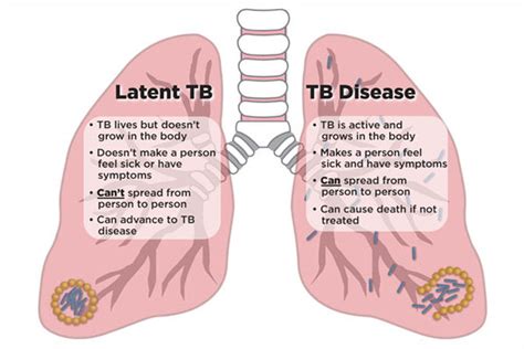 Hiv And Tuberculosis Tb Thebody