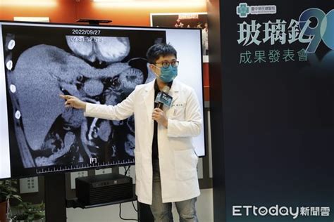 肝癌患者福音 中榮「玻璃釔90微球治療」提高存活率 Ettoday生活新聞 Ettoday新聞雲