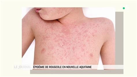 Épidémie de rougeole en Nouvelle Aquitaine La mort en face en replay