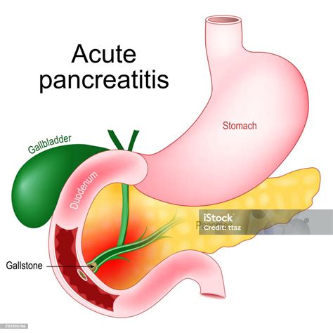 Acute Pancreatitis Pancreas Inflammation Stock Illustration Download Image Now Abdomen