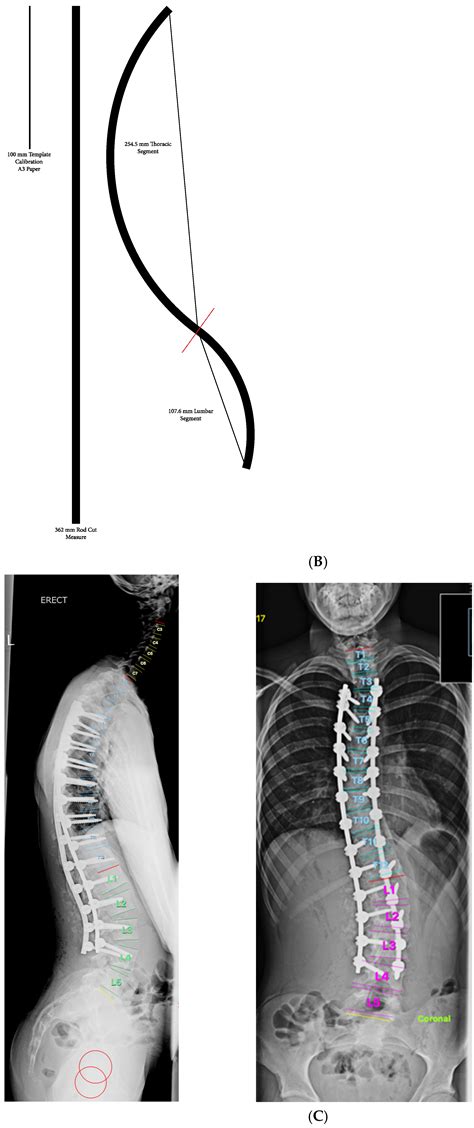 Healthcare Free Full Text Correction Of Thoracic Hypokyphosis In Adolescent Scoliosis Using