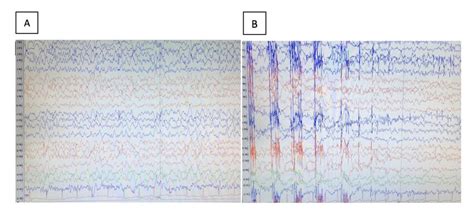 The Electroencephalogram Illustrates Electrographic Seizure A And B