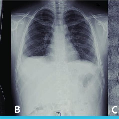 Imaging studies demonstrating a ruptured right renal abscess with... | Download Scientific Diagram