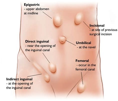 Hernia Surgery Medicover