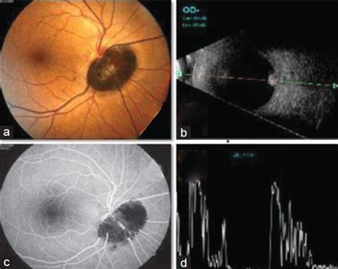 Melanocytoma Over Optic Nerve Head A Fundus Photo Posterior Pole Download Scientific Diagram