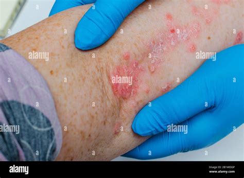 Eczema Atopic Dermatitis Close Up Fotografías E Imágenes De Alta