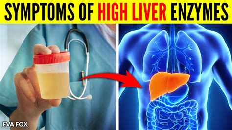 Signs And Symptoms Of High Liver Enzymes Causes And Treatment Youtube