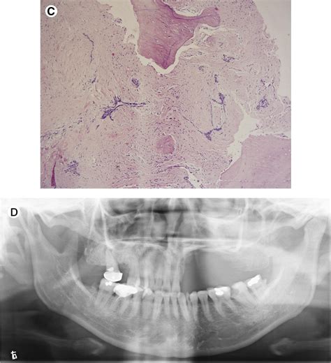 Clinical And Radiologic Features Of Desmoplastic Ameloblastoma