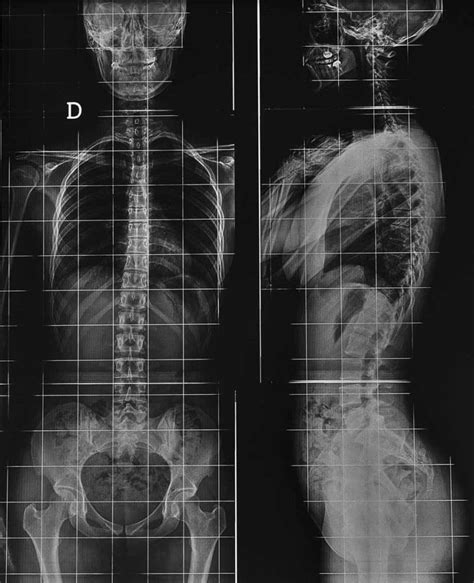 radiographie - Chirurgie rachidienne