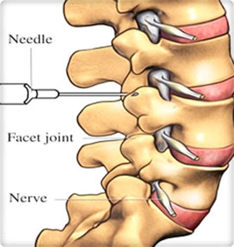 Facet Injections | Dr. Mark Valente - Dallas Spine Surgeon