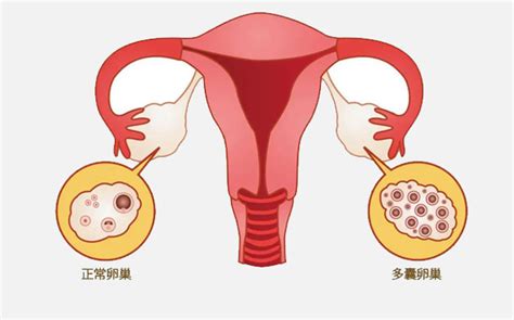 西安生殖保健院不孕不育医院：多囊卵巢综合症能怀孕吗？凤凰网区域凤凰网