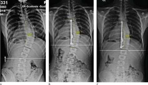 Fusionless Correction Of Moderate Adolescent Idiopathic Scoliosis With