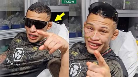 Brutal Así quedo el rostro de Lazy Boy tras pelea en UFC 306 TUDN