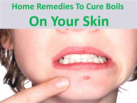 PPT - Home remedies to cure boils on your skin PowerPoint Presentation ...