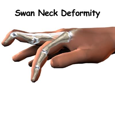 Swan Neck Deformity : Cause, Symptom, Diagnosis, Treatment