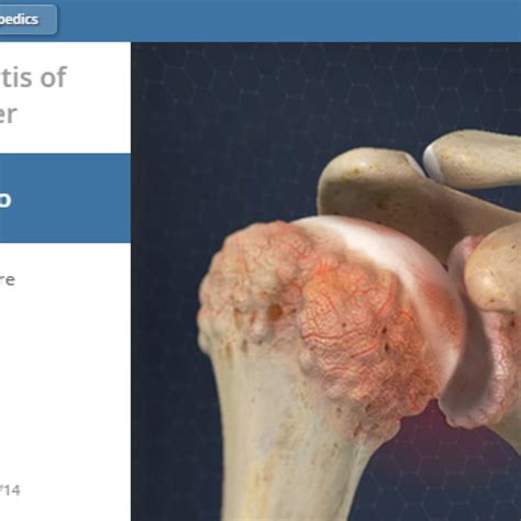 Shoulder Osteoarthritis | Manhattan Orthopedic Care