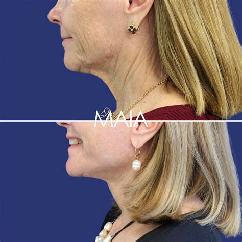 Washington Dc Neck Lift Surgery Before And After Pictures Tysons Corner