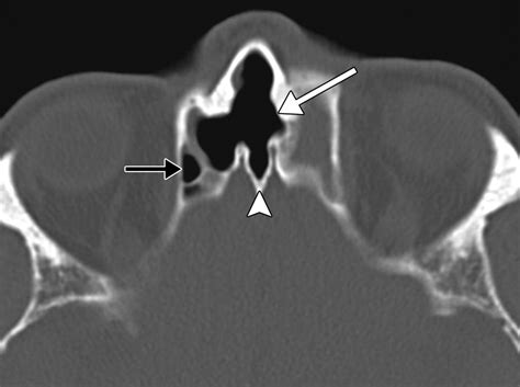 Failed Endoscopic Sinus Surgery Spectrum Of Ct Findings In The Frontal