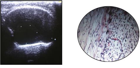 Cyst: Ultrasound showing fluid filled anechoic area suggestive of ...