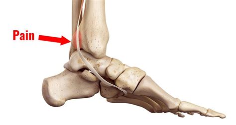 Tibialis Posterior Tendonitis Tendinopathy