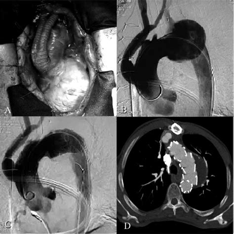 A) The intraoperative view of the ascending aorta after debranching the ...