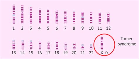 Turner syndrome Karyotype