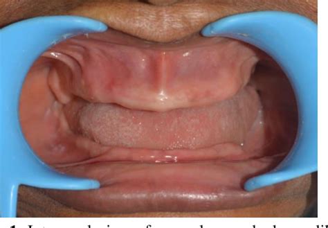 Figure 2 From PROSTHODONTIC REHABILITATION OF A SEVERELY RESORBED