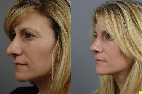 Revision Rhinoplasty Before After Patient 01 Dr Marotta