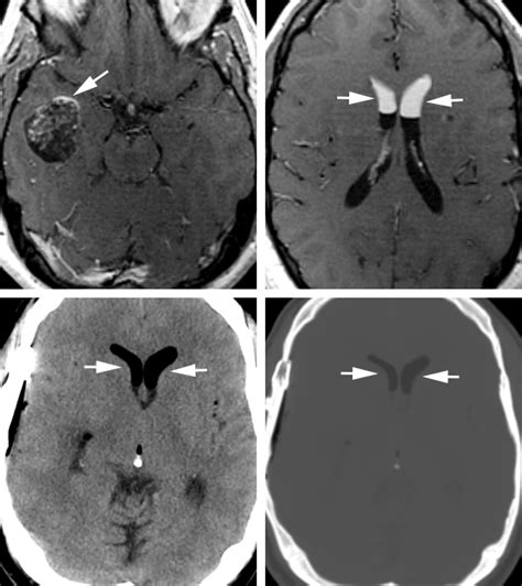 Dermoid Cyst The Neurosurgical Atlas By Aaron Cohen Gadol M D