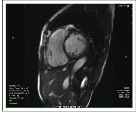 Cardiac Magnetic Resonance Imaging Mri With Short Axis View Of The