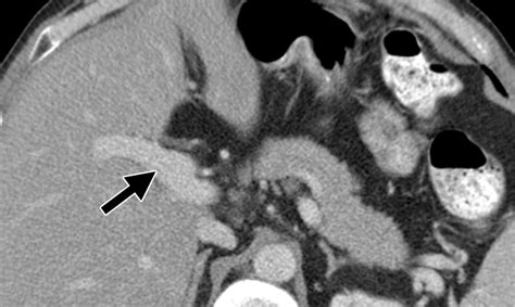 Ct Findings In Adult Celiac Disease Radiographics